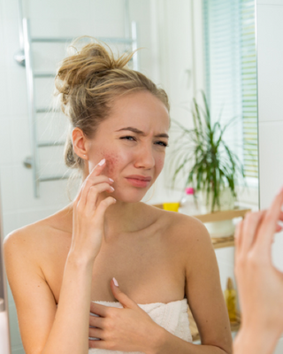 An Inside Look at Acne